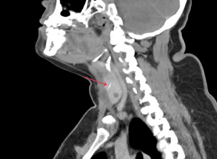 CT Image showing Fish bone in saggital view