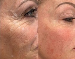 7 POWERFUL SKIN TRANSFORMATIONS YOU CAN EXPERIENCE WITH A CHEMICAL PEEL IN DUBAI